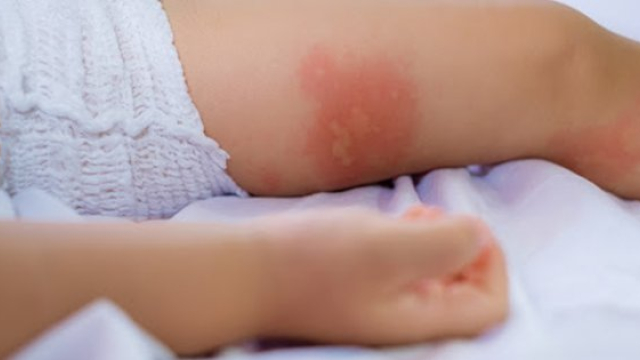 Mengenai Ruam Popok Akibat Dermatitis Iritan